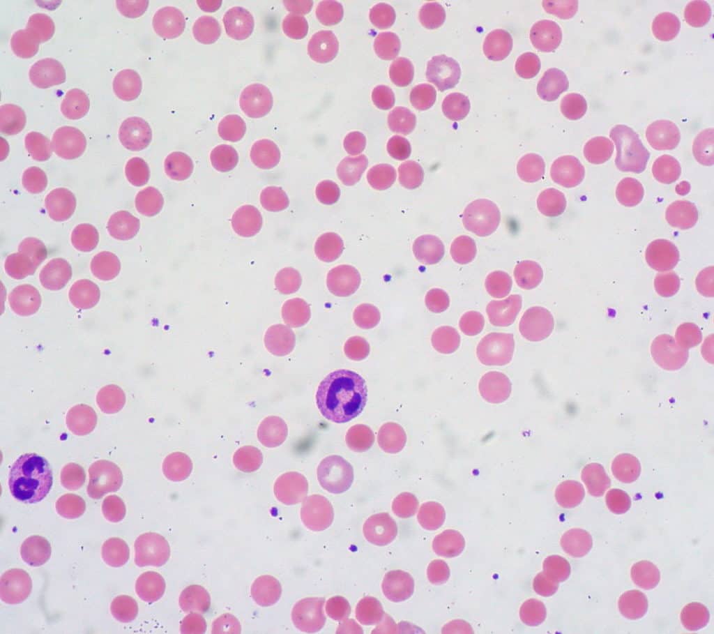 Microscopic slide of warm autoimmune hemolytic anemia